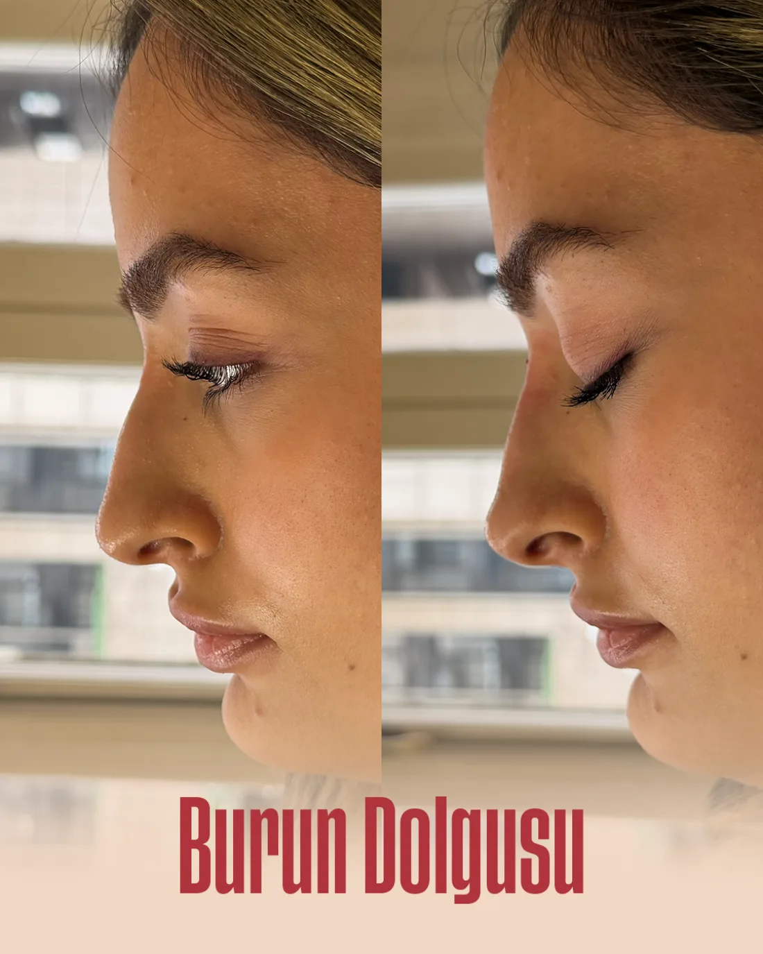 Burun Dolgusu