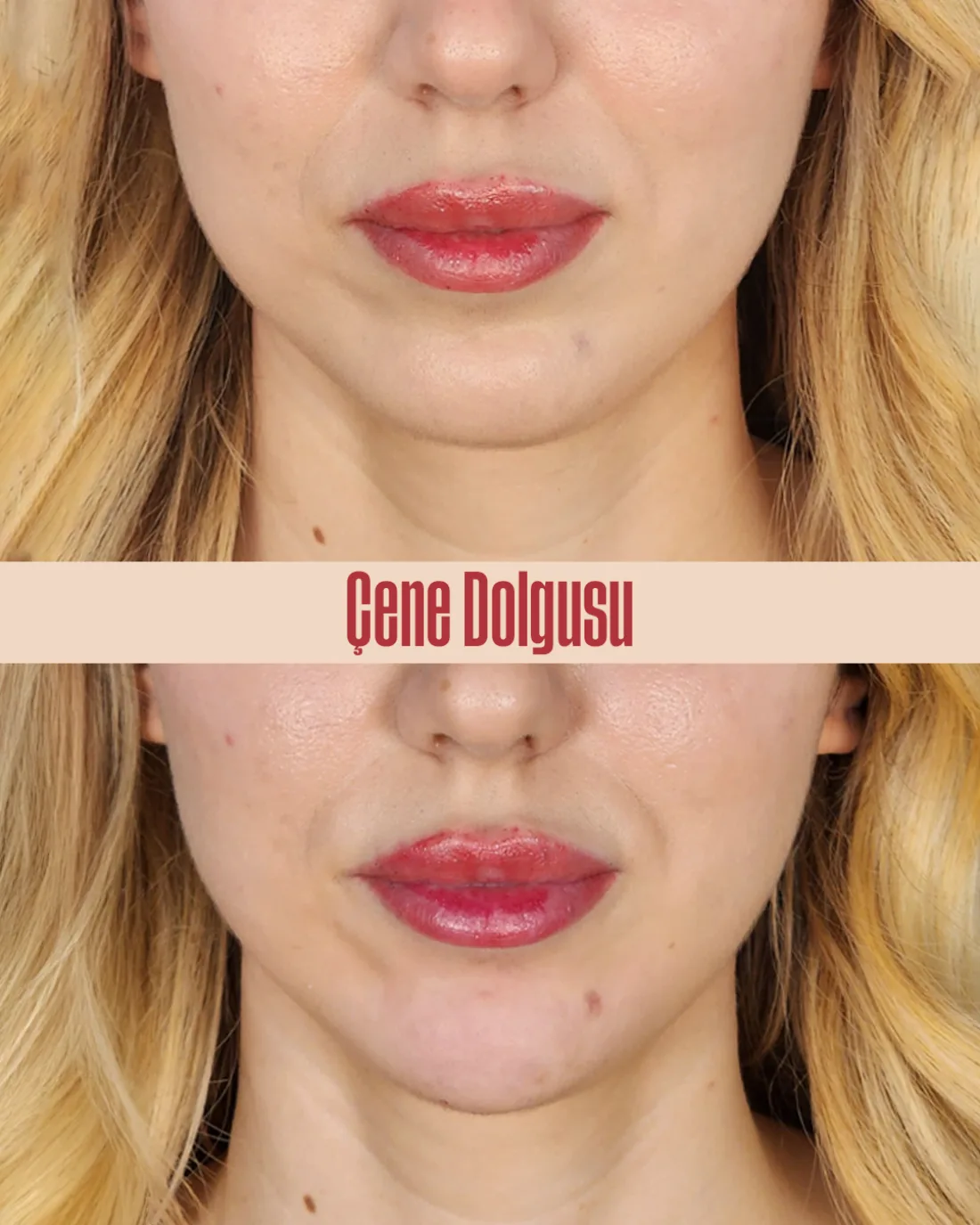 Jawline (Çene) Dolgusu